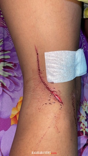 Foto korban penganiayaan Seorang Pemuda Asal Kelurahan Wundumbatu