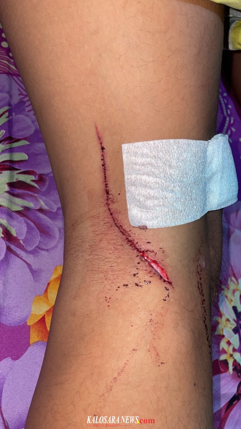 Foto korban penganiayaan Seorang Pemuda Asal Kelurahan Wundumbatu